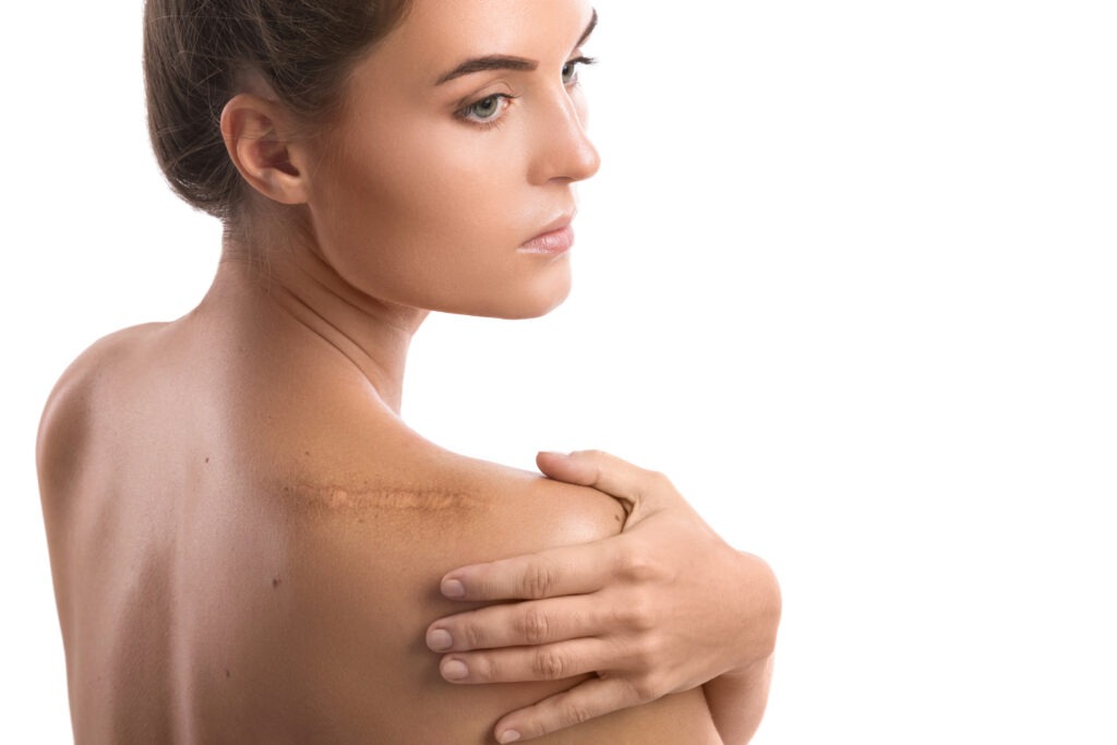 First Steps Of Scar Treatment
